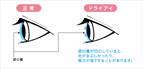 ドライアイ